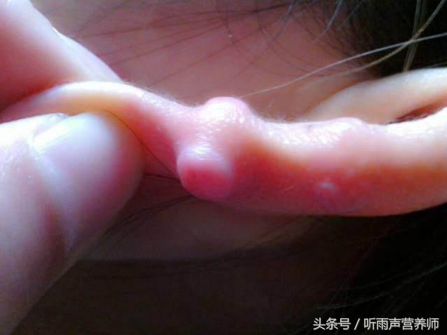 打完耳洞不能沾水,打完耳洞之后不能吃什么