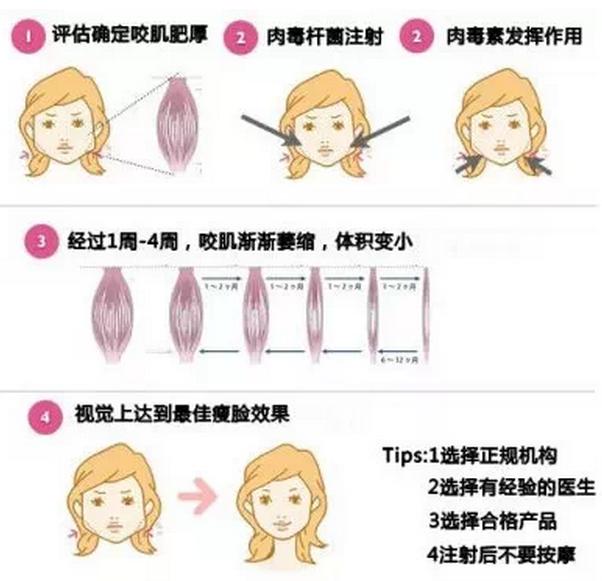 瘦脸针有基础版跟加强版吗,瘦脸针打一支有效果吗