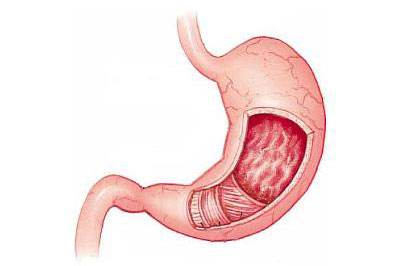 浅表性胃炎伴糜烂中医治疗方法,慢性浅表性胃炎中医好还是西医好