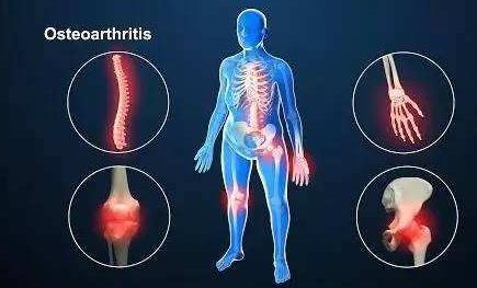 骨关节炎最新诊疗指南,骨关节前十医院