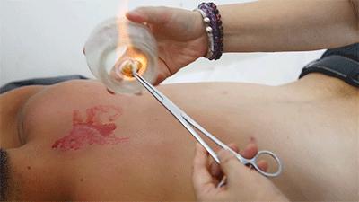 拔罐的好处和拔罐方法关注事项,拔罐慎重