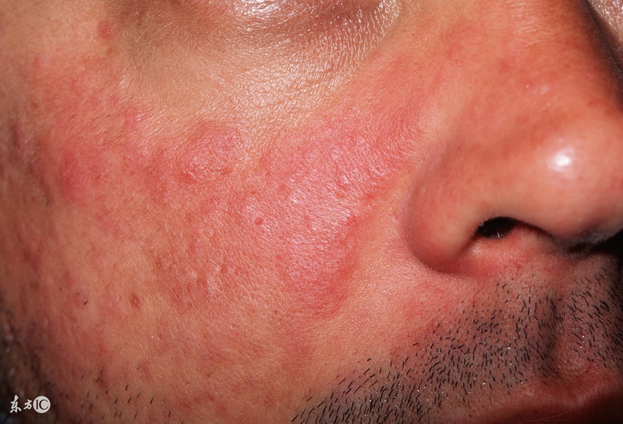 红斑狼疮这样记忆治疗，想不懂都难！