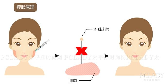 瘦脸针有基础版跟加强版吗,瘦脸针打一支有效果吗