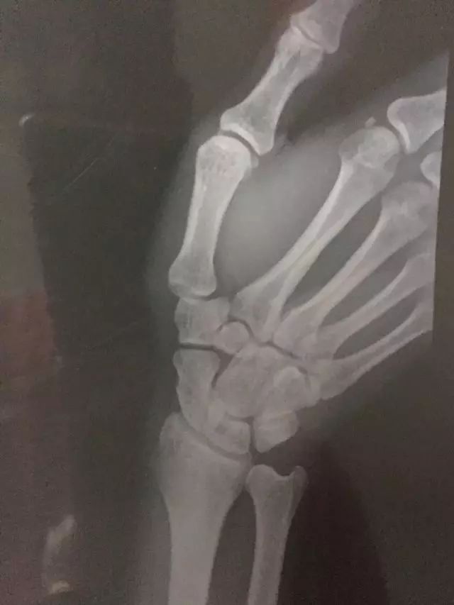 网球肘详细讲解,网球肘的最佳打法