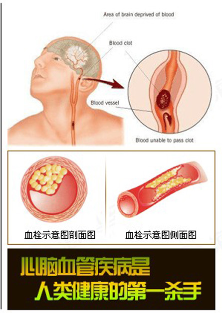 脑供血不够几种病因,椎管狭窄脑供血不够病因
