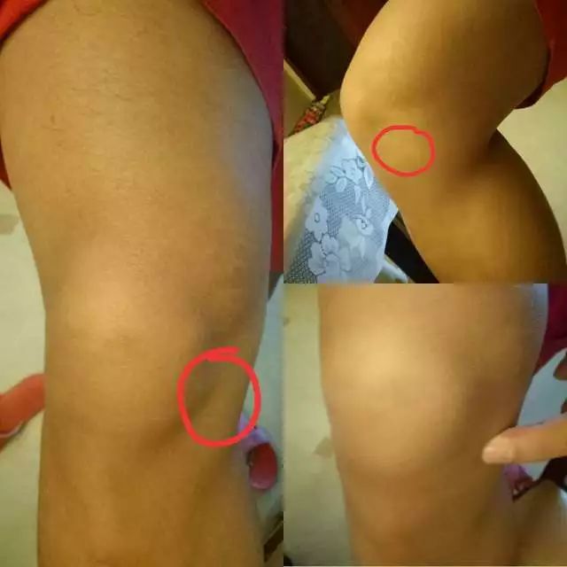 网球肘详细讲解,网球肘的最佳打法