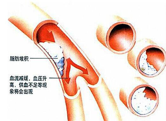 脑供血不够几种病因,椎管狭窄脑供血不够病因