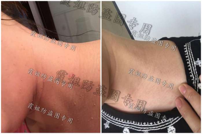 扁平疣｜快去点掉你的扁平疣，别传染给我