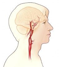 脑供血不够几种病因,椎管狭窄脑供血不够病因