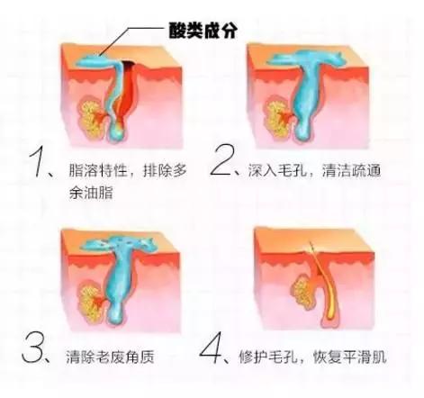 痘痘闭口摸起来软软的,痘痘摸上去硬硬反反复复