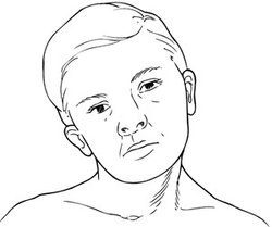 小儿斜颈治疗方法,斜颈的治疗方法与时间