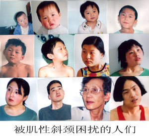 小儿斜颈治疗方法,斜颈的治疗方法与时间