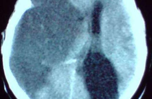 针灸治疗脑梗塞后遗症效果好吗,脑梗塞后遗症头痛怎么治疗