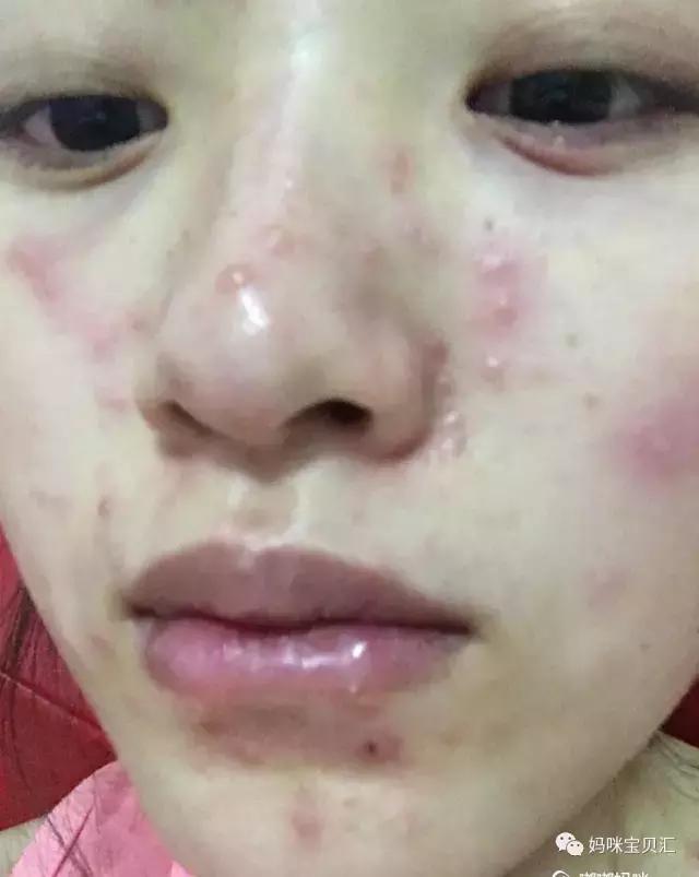 妊娠期发生水痘对胎儿的影响,孕妇怀孕26长水痘对胎儿有影响吗