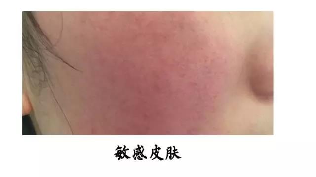 脂溢性皮炎和玫瑰痤疮会并发吗,脂溢性皮炎和玫瑰痤疮的区别