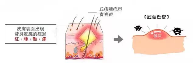 痘痘闭口摸起来软软的,痘痘摸上去硬硬反反复复