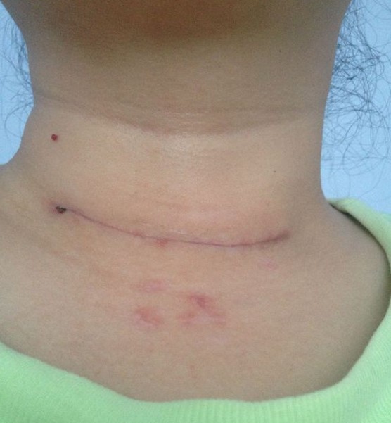 甲状腺不好总会肩颈紧张,甲状腺不好容易发脾气