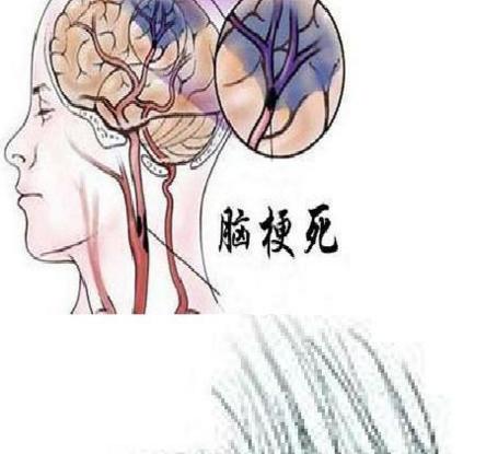 针灸治疗脑梗塞后遗症效果好吗,脑梗塞后遗症头痛怎么治疗