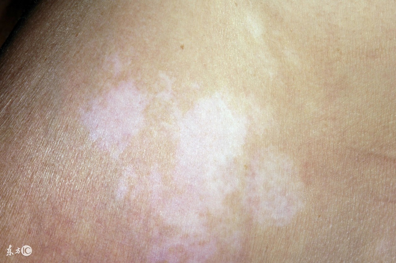 白癜风可以治愈吗用什么方式最佳,白癜风能治愈吗概率多大