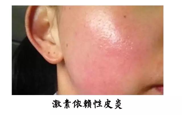 脂溢性皮炎和玫瑰痤疮会并发吗,脂溢性皮炎和玫瑰痤疮的区别