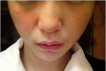 脸上皮肤严重缺水怎么补救,严重缺水皮肤怎么改善