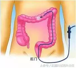 无痛肠镜检查的亲身经历,无痛肠镜真的一点都感觉不到吗