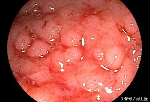 溃疡性结肠炎初期症状及治疗,溃疡性结肠炎症状最新治疗方法