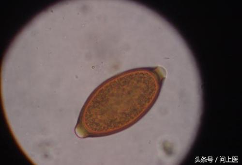 溃疡性结肠炎初期症状及治疗,溃疡性结肠炎症状最新治疗方法