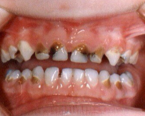 一颗糖都没有吃过的六岁小孩，却烂全牙，父母居然被医生骂无知