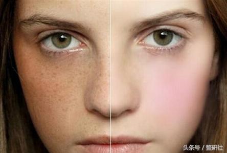 光电美肤美容项目,光电美肤效果怎么样