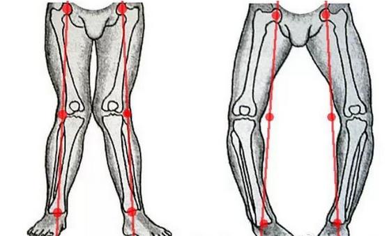 怎样改善x腿型和o腿型,通过调整脚型来改善x型腿