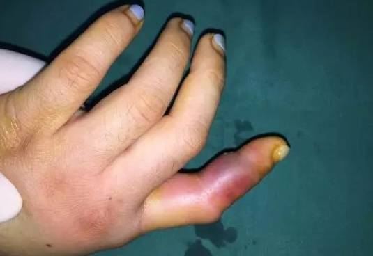 徐州一老师被牙签扎伤，去5次医院都没治好，最后竟然要手术！