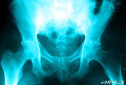 溃疡性结肠炎初期症状及治疗,溃疡性结肠炎症状最新治疗方法