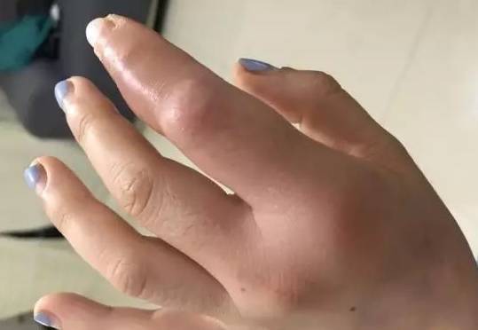 徐州一老师被牙签扎伤，去5次医院都没治好，最后竟然要手术！