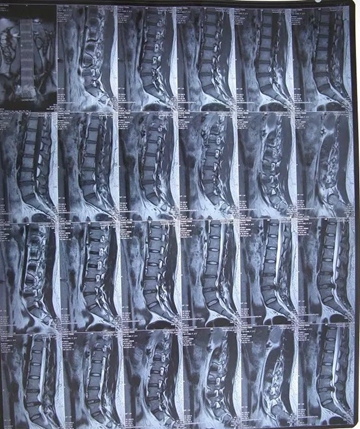 腰椎间盘膨出突出和脱出的区别,腰椎间盘突出膨出脱出哪个更严重