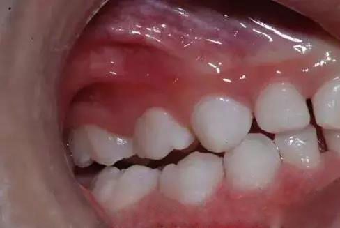 牙齿槽沟黑了还有办法去掉吗,怎样去掉牙齿上的黑垢