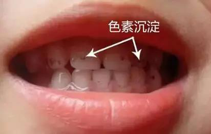 牙齿槽沟黑了还有办法去掉吗,怎样去掉牙齿上的黑垢