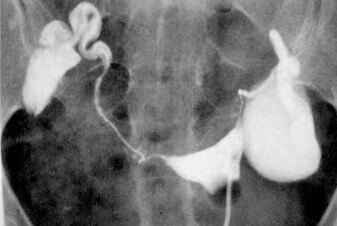 试管前发现有输卵管积水怎么办,试管婴儿要做输卵管造影么