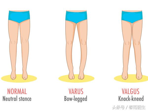 孩子腿有点弯怎么变直,小孩绑腿能使腿变直吗