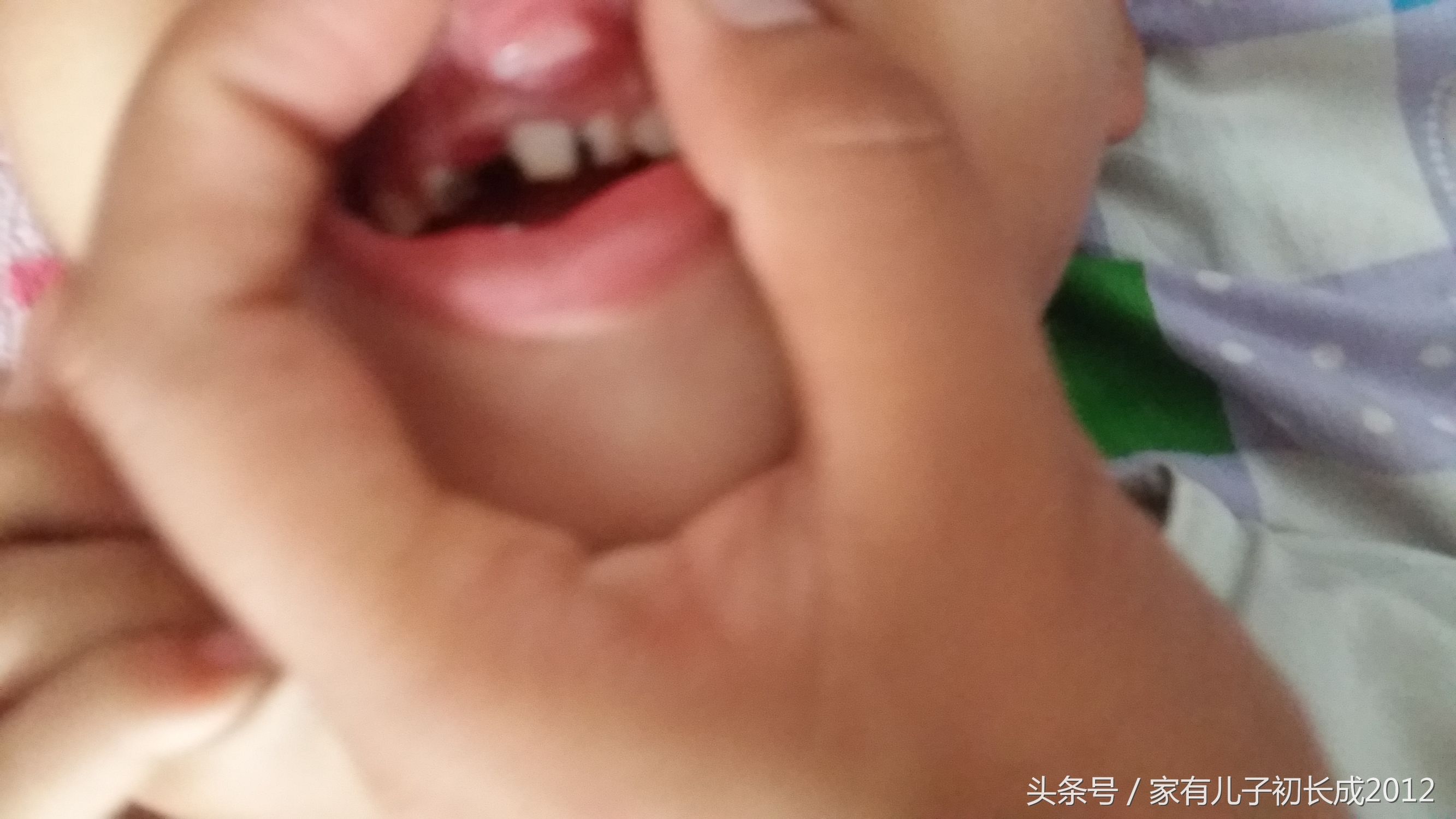 乳牙还没脱落恒牙就萌出了怎么办,6岁孩子乳牙未脱落里面又长新牙