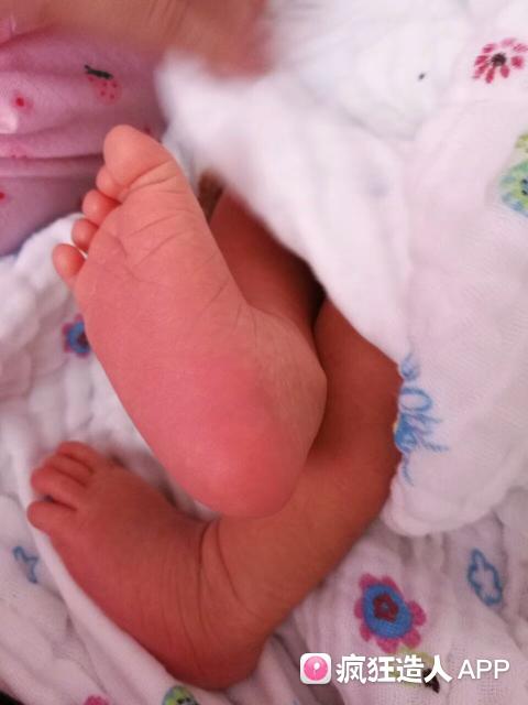 开指疼的受不了怎么办,开指很痛有减轻疼痛的方法吗