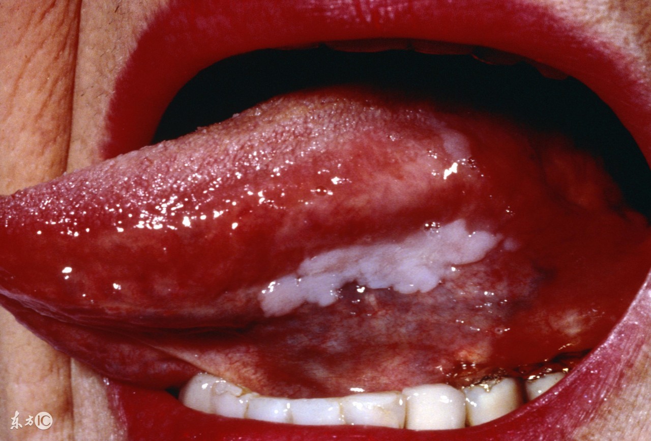 外阴白斑会导致癌变么,外阴白斑会引起癌变吗