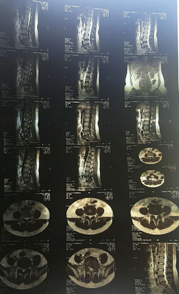 腰椎间盘膨出突出和脱出的区别,腰椎间盘突出膨出脱出哪个更严重
