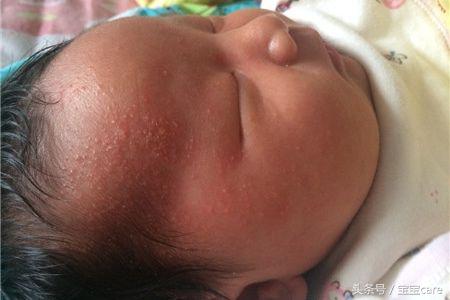 宝宝身上长密密麻麻小疙瘩怎么办,宝宝身上长小疙瘩不红