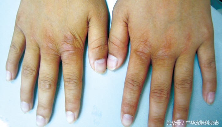 手部发黑怎么回事,摩擦性黑变病的症状有哪些