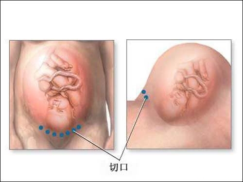 剖腹产麻醉对身体副作用,剖腹产麻醉对身体的危害