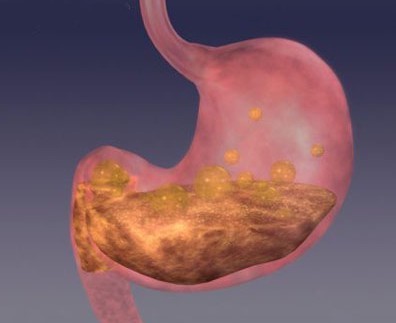 萎缩性胃炎c3伴hp感染怎么治疗,萎缩性胃炎伴肠化生需要关注什么