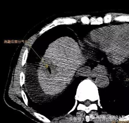 治癌手术,肿瘤消融术能治什么癌症