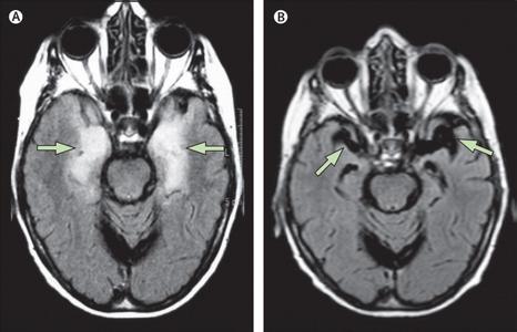 怎么预防单纯性疱疹,预防疱疹的最好方法