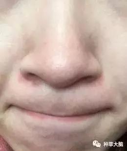 面部脂溢性皮炎怎么治才能断根,头上脂溢性皮炎怎么治疗最彻底